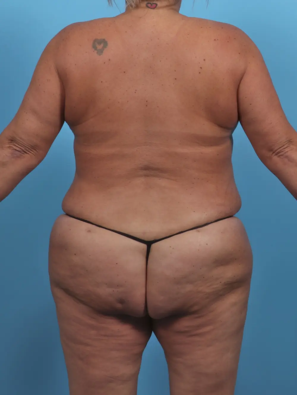 Breast Lift/Reduction w/o Implants Patient Photo - Case 46637 - after view-3