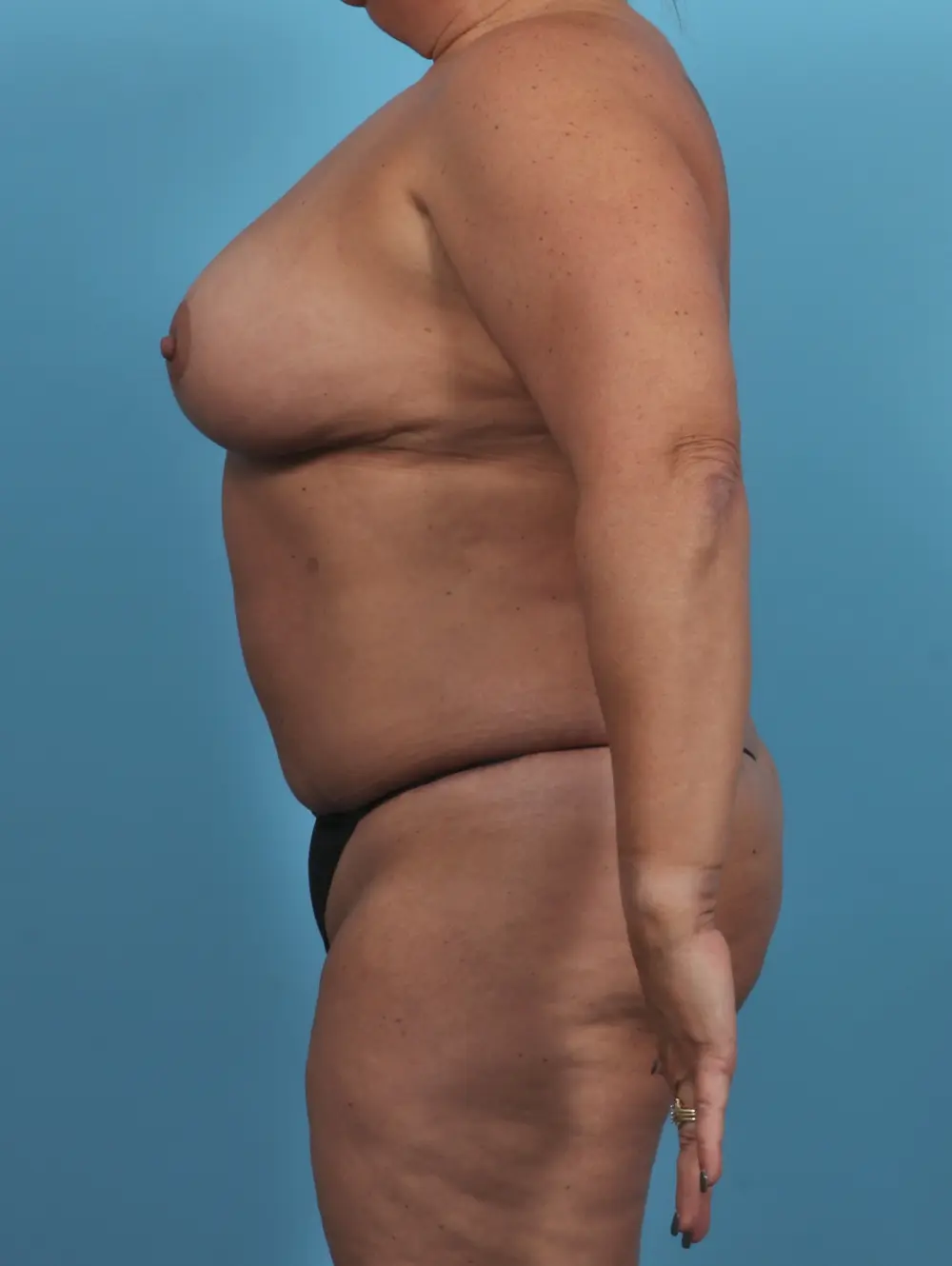 Breast Lift/Reduction w/o Implants Patient Photo - Case 46637 - after view-2