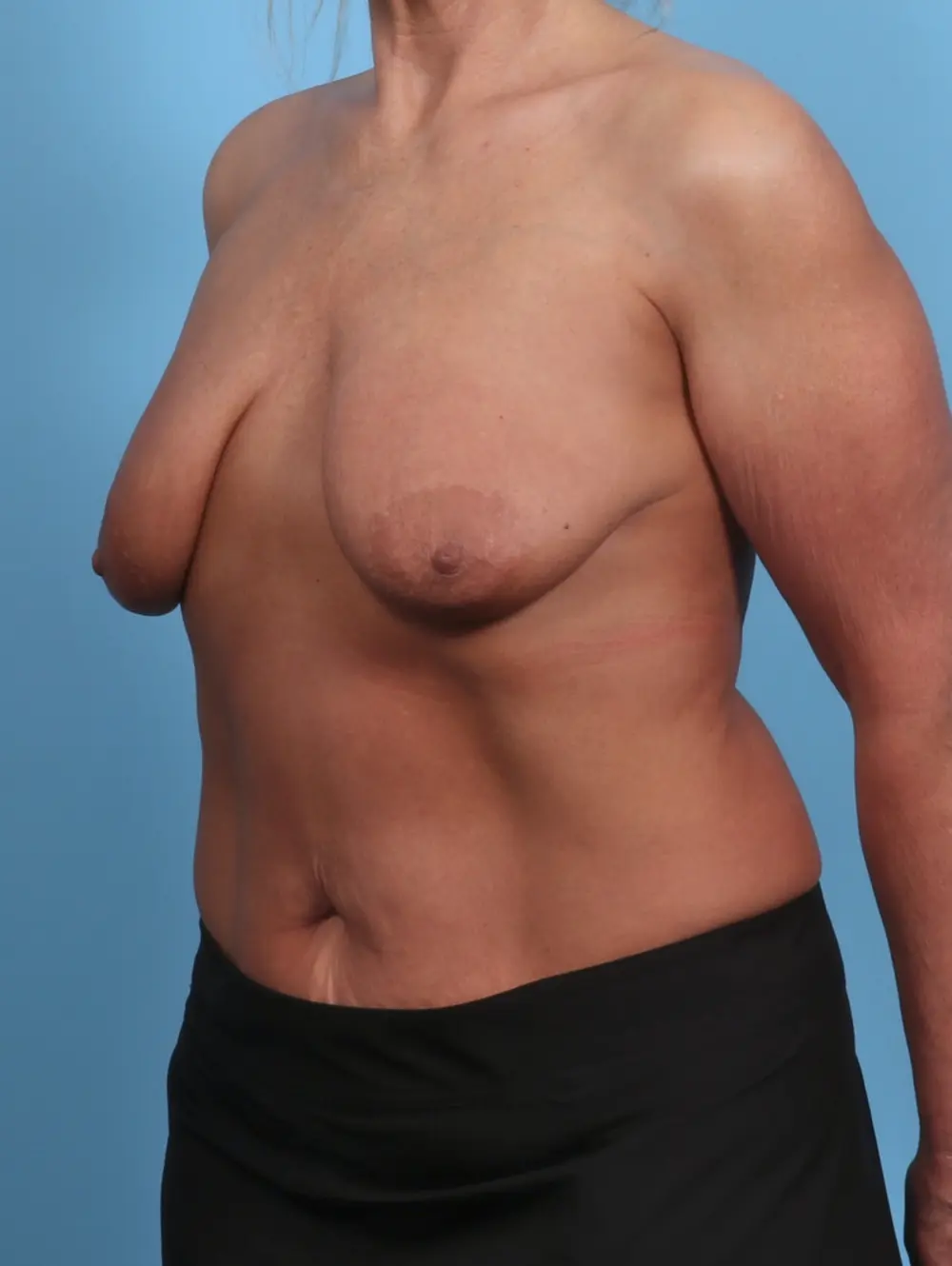 Breast Lift/Reduction with Implants Patient Photo - Case 46663 - before view-1