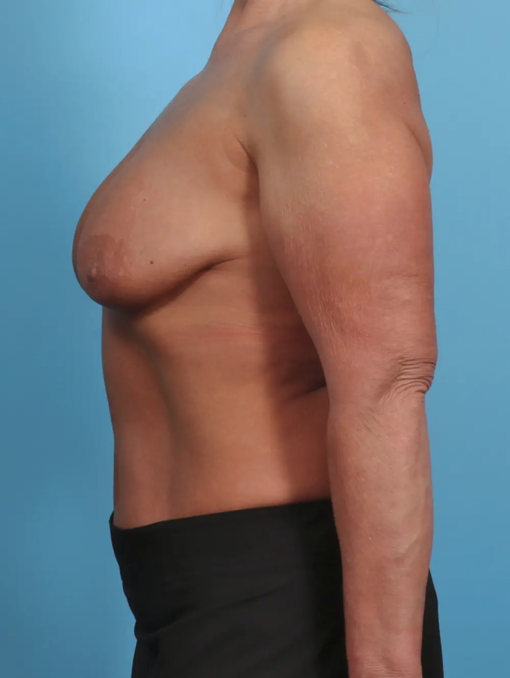Breast Lift/Reduction with Implants Patient Photo - Case 46663 - before view-2