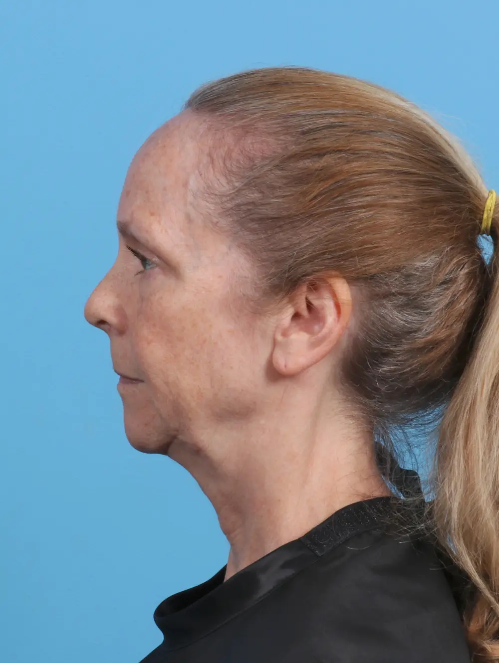 Brow Lift Patient Photo - Case 46671 - before view-2