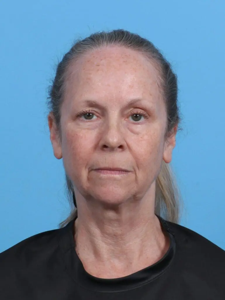 Brow Lift - Case 46671 - Before