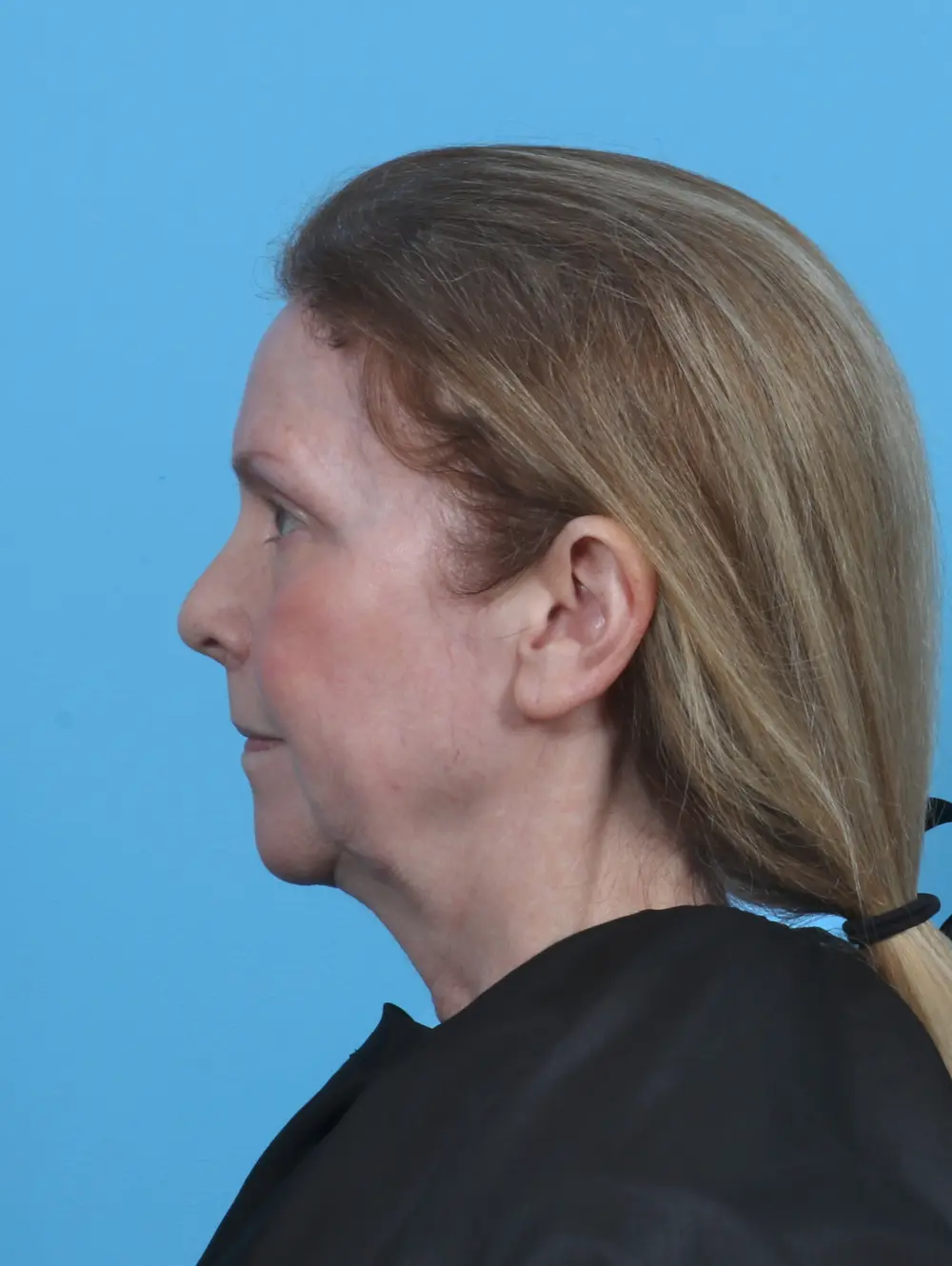 Brow Lift Patient Photo - Case 46671 - after view-2