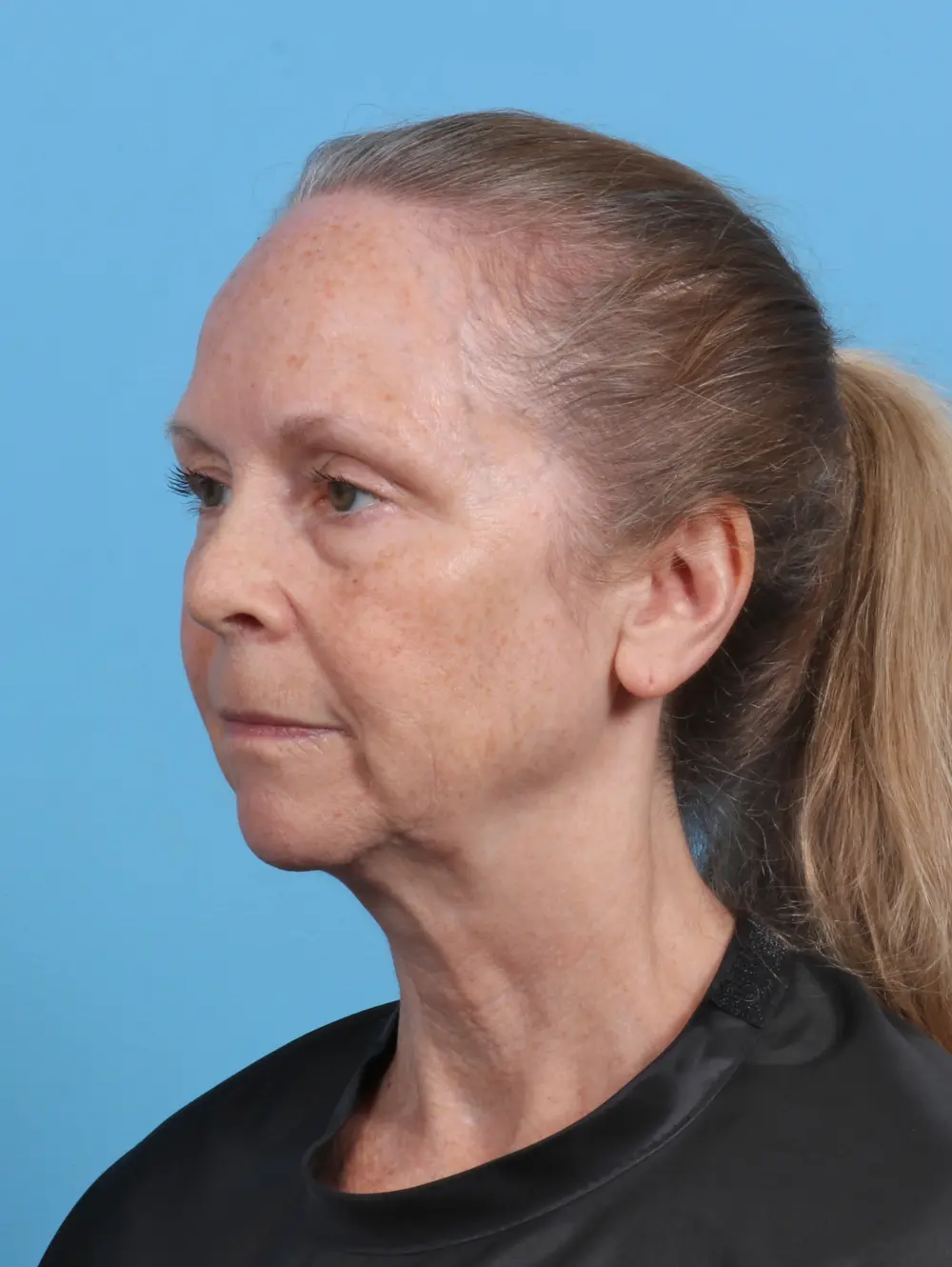 Brow Lift Patient Photo - Case 46671 - before view-1