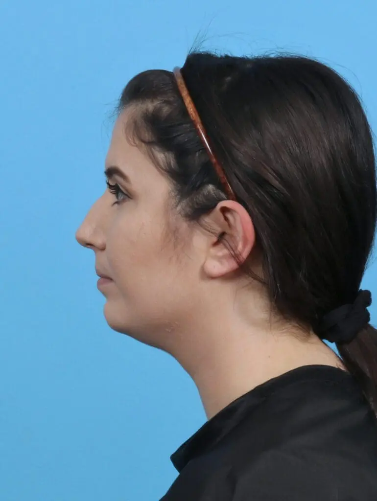 Chin Implant - Case 46695 - Before