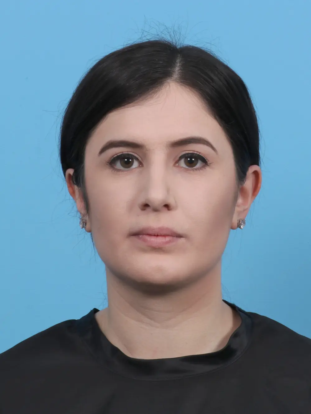 Chin Implant Patient Photo - Case 46695 - after view-2