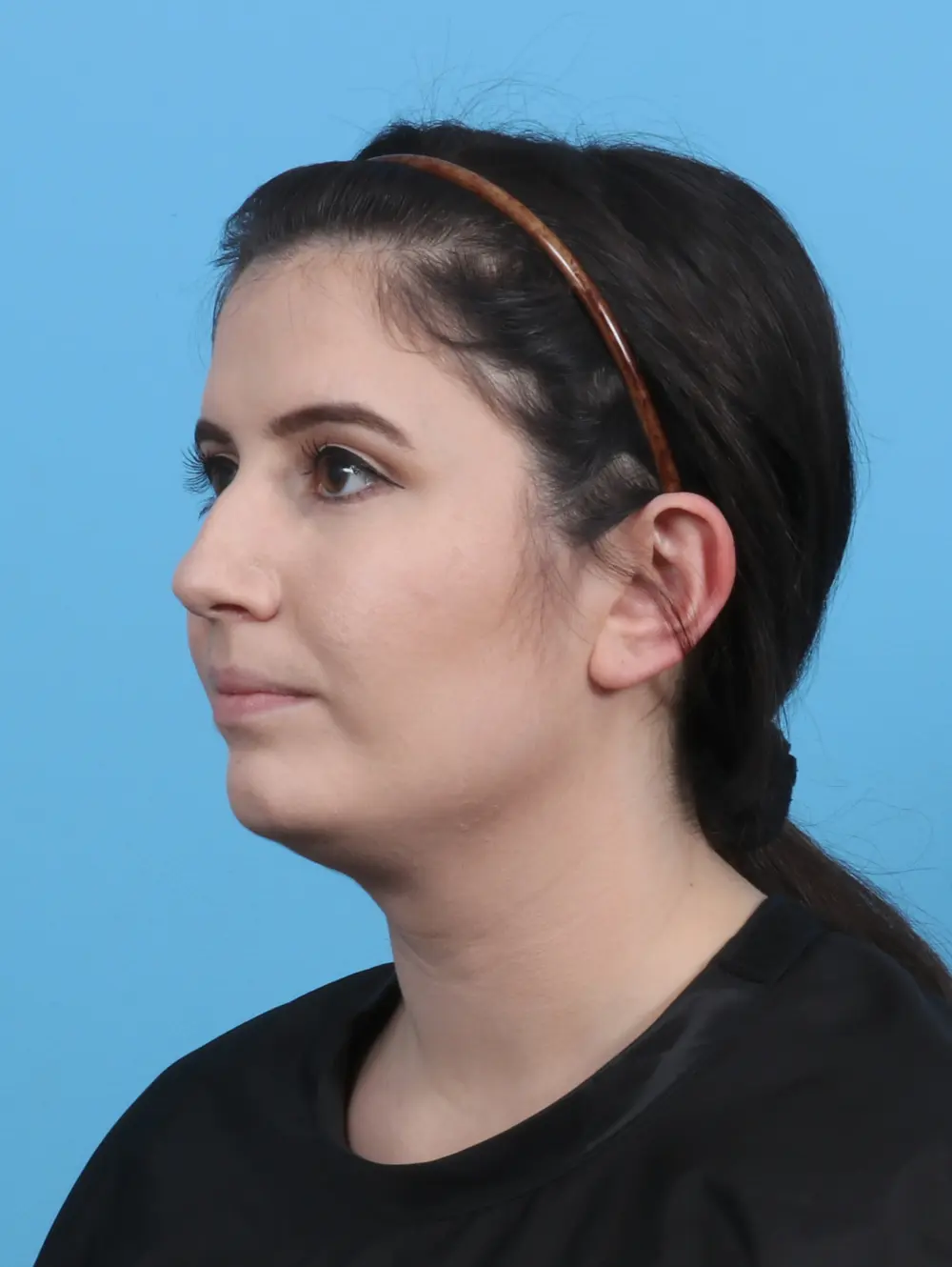 Chin Implant Patient Photo - Case 46695 - before view-1