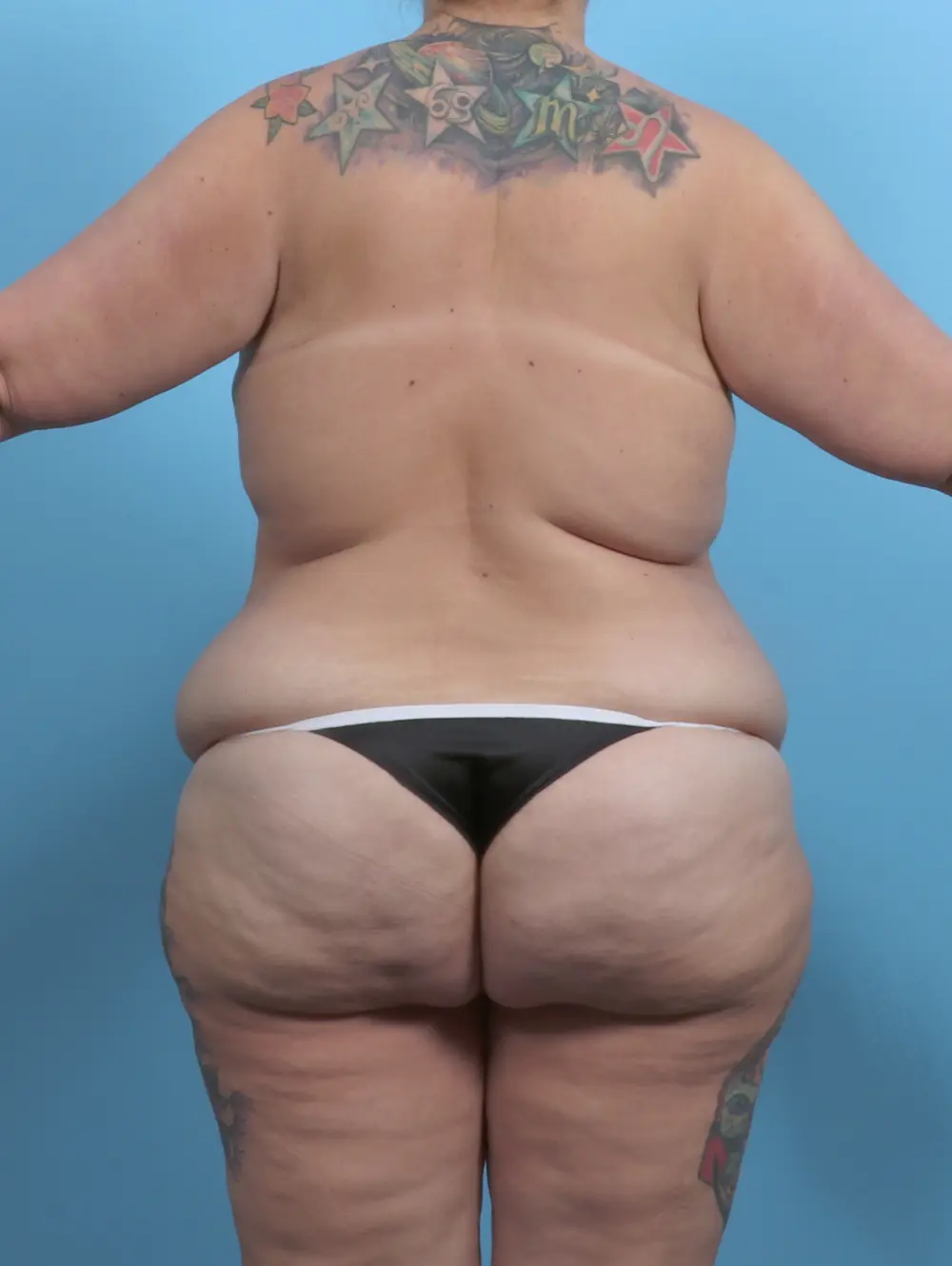 Body Lift Patient Photo - Case 46703 - before view-3