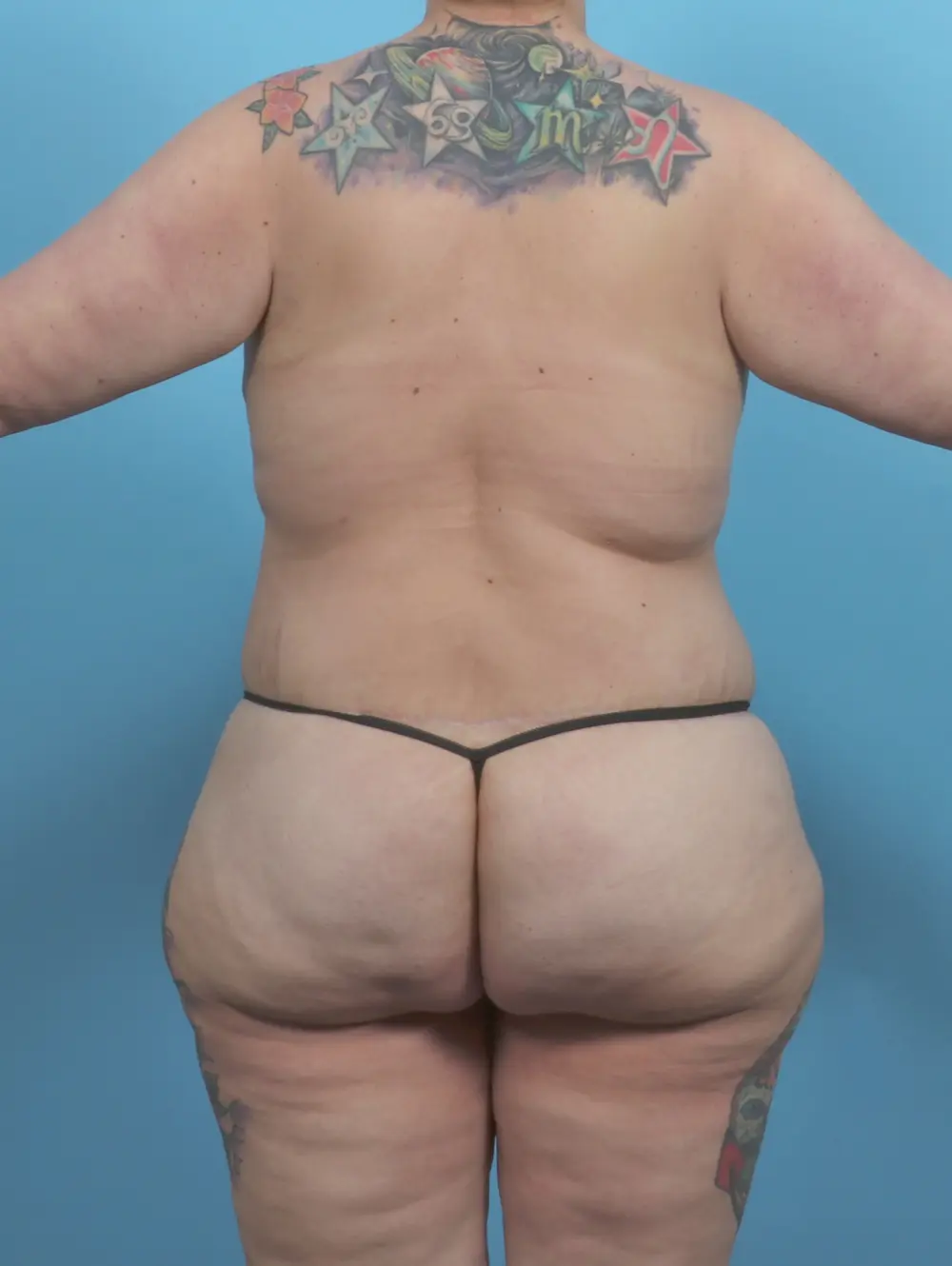 Body Lift Patient Photo - Case 46703 - after view-3