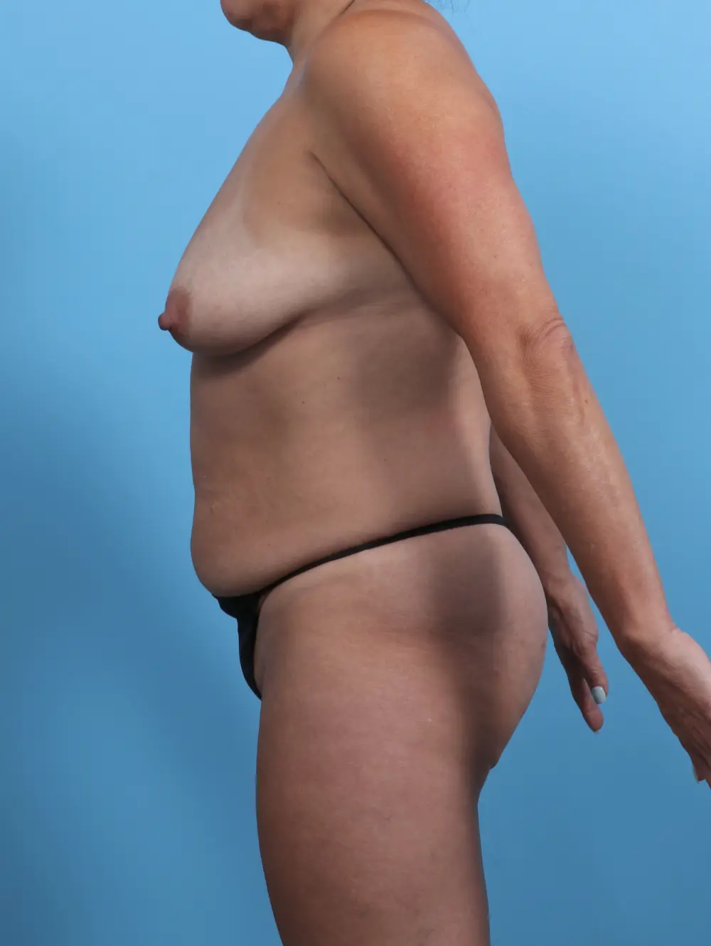 Breast Lift/Reduction with Implants Patient Photo - Case 46724 - before view-2