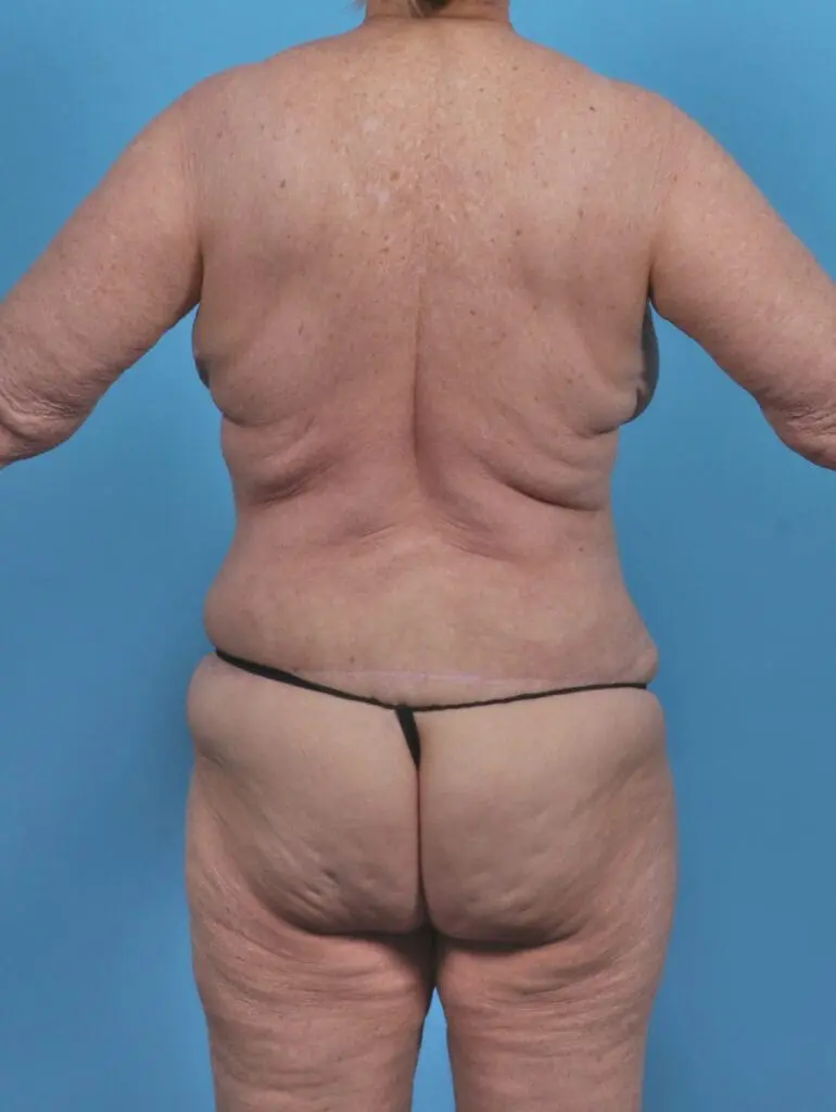 Body Lift - Case 46742 - After