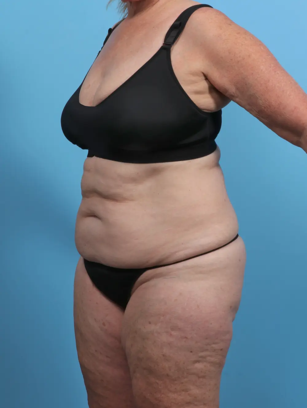 Tummy Tuck Patient Photo - Case 46746 - before view-1
