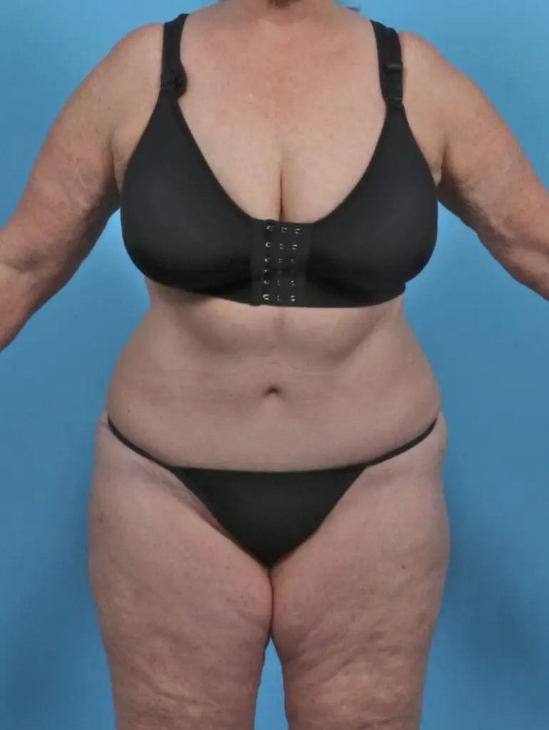 Tummy Tuck - Case 46746 - After