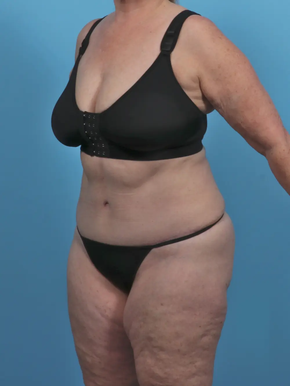 Tummy Tuck Patient Photo - Case 46746 - after view-1