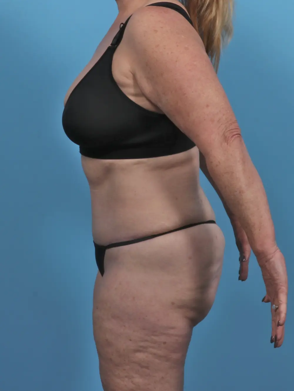 Tummy Tuck Patient Photo - Case 46746 - after view-2