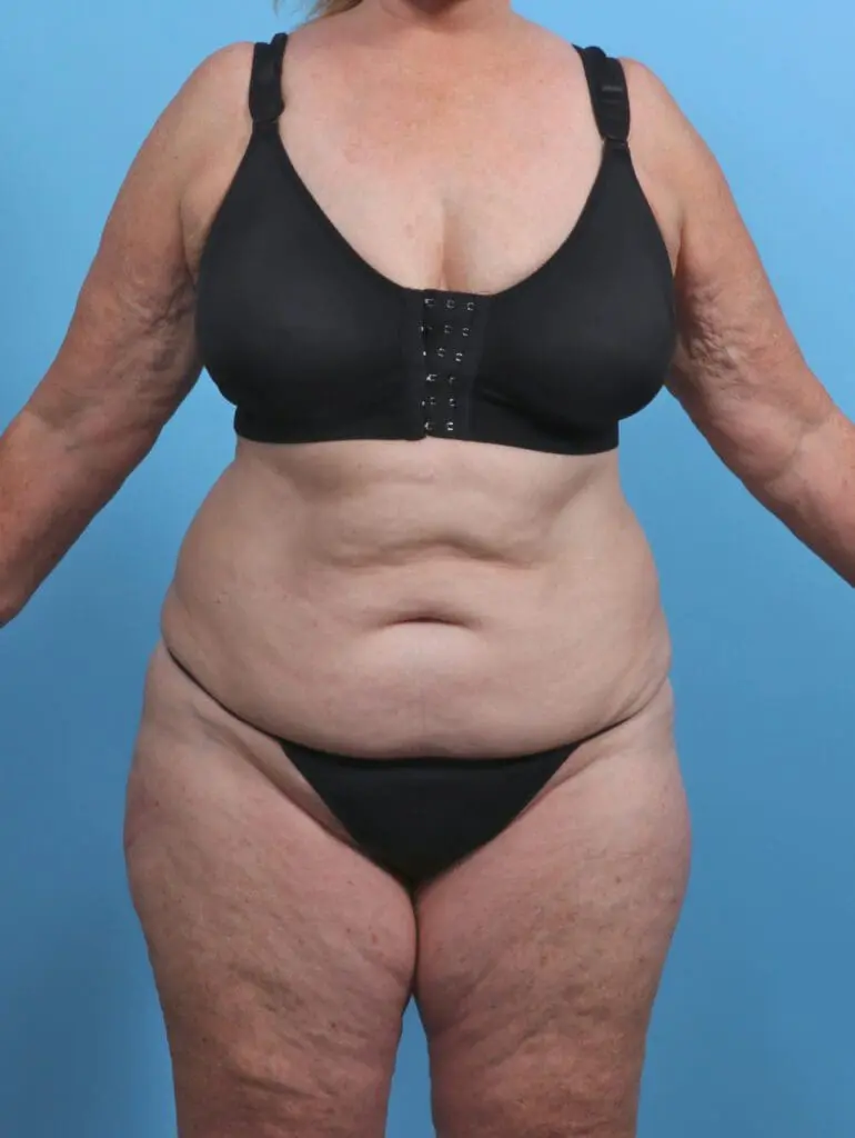 Tummy Tuck - Case 46746 - Before