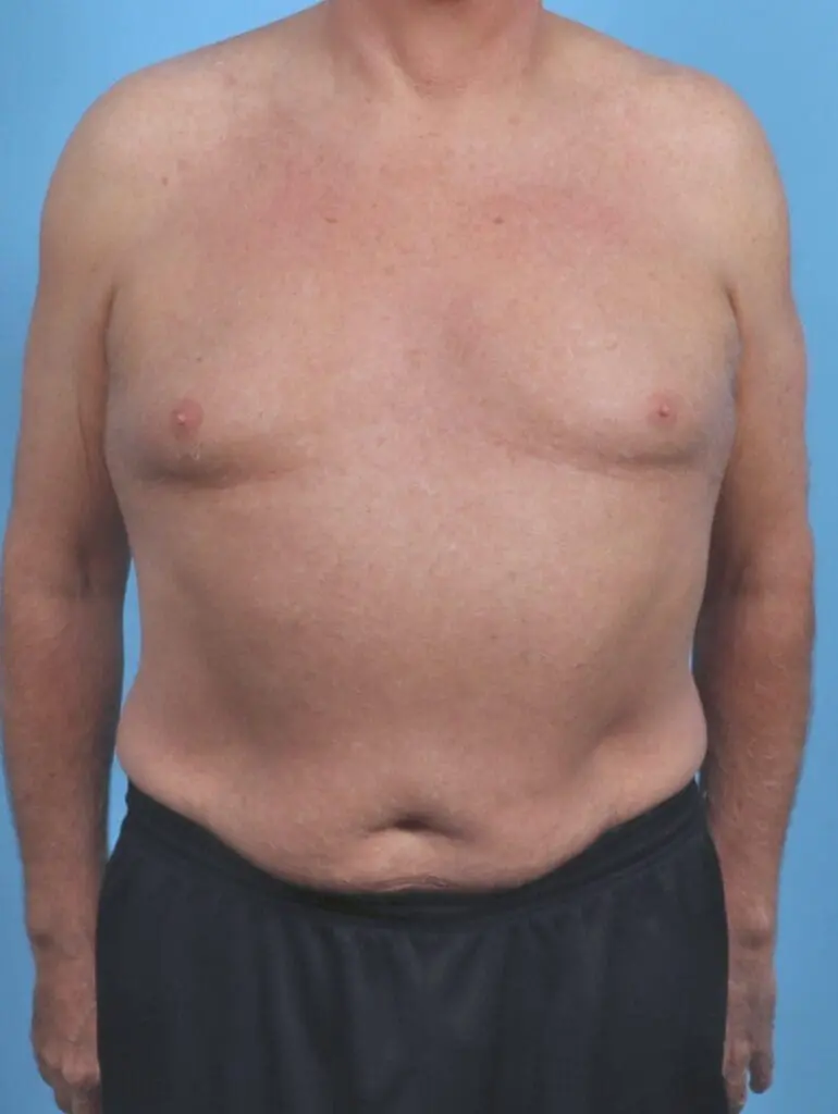 Gynecomastia - Case 46756 - Before