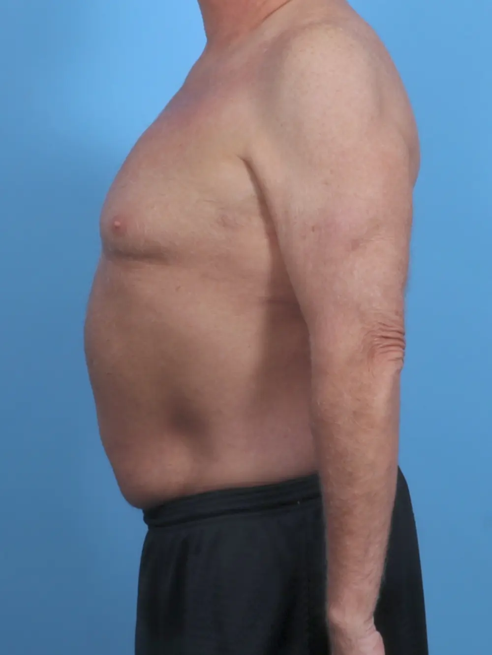 Gynecomastia Patient Photo - Case 46756 - before view-2