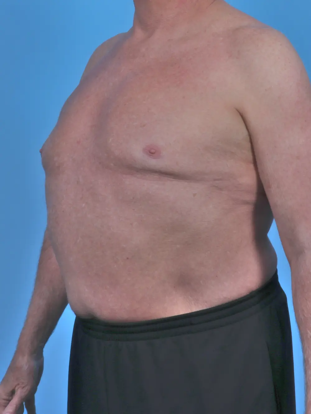 Gynecomastia Patient Photo - Case 46756 - after view-1
