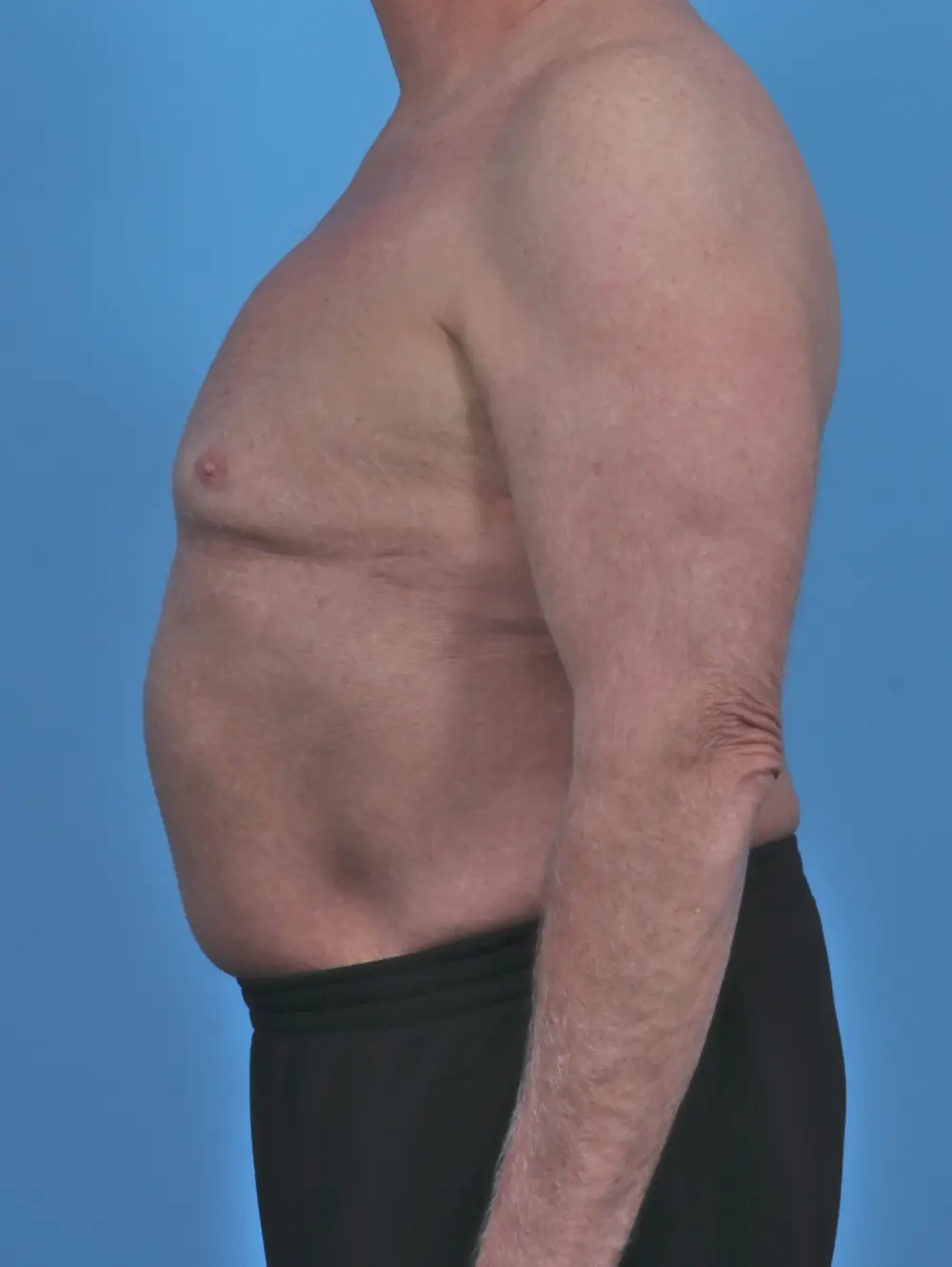 Gynecomastia Patient Photo - Case 46756 - after view-2