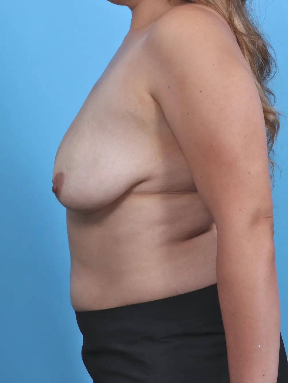 Breast Lift/Reduction with Implants Patient Photo - Case 46764 - before view-2