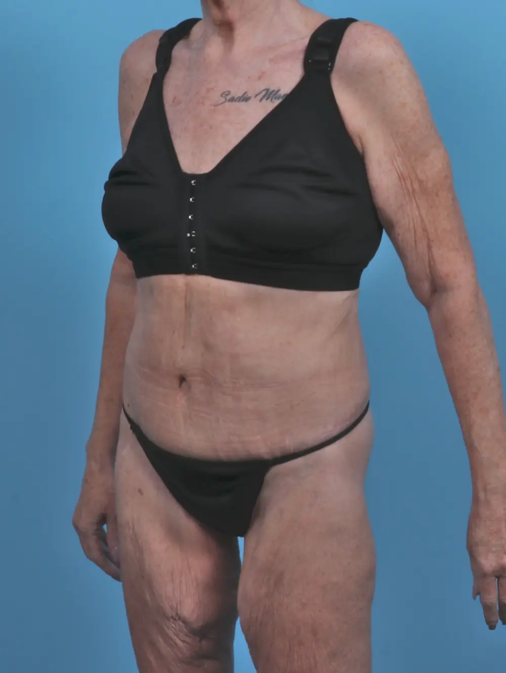 After Weight Loss Patient Photo - Case 46772 - after view-1