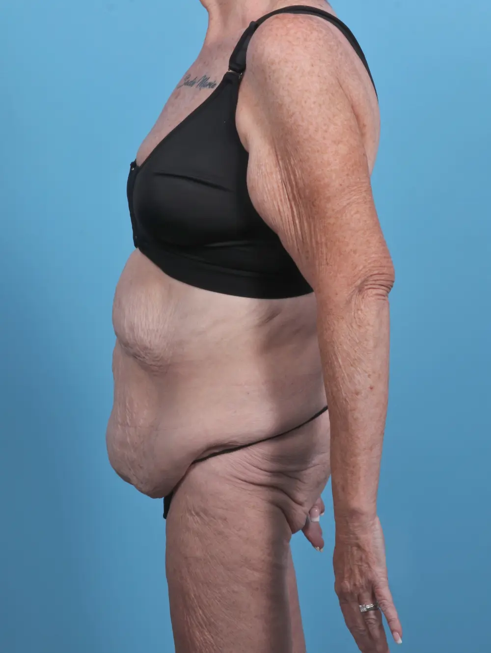 After Weight Loss Patient Photo - Case 46772 - before view-2