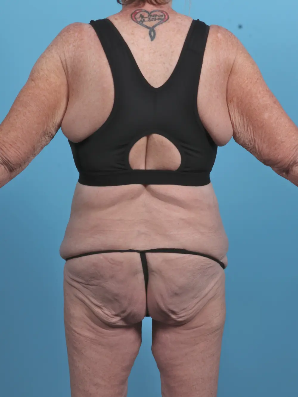 After Weight Loss Patient Photo - Case 46772 - before view-3