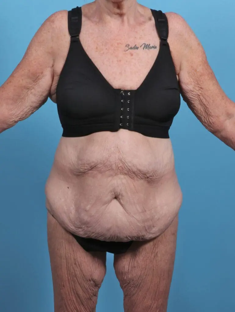 After Weight Loss - Case 46772 - Before