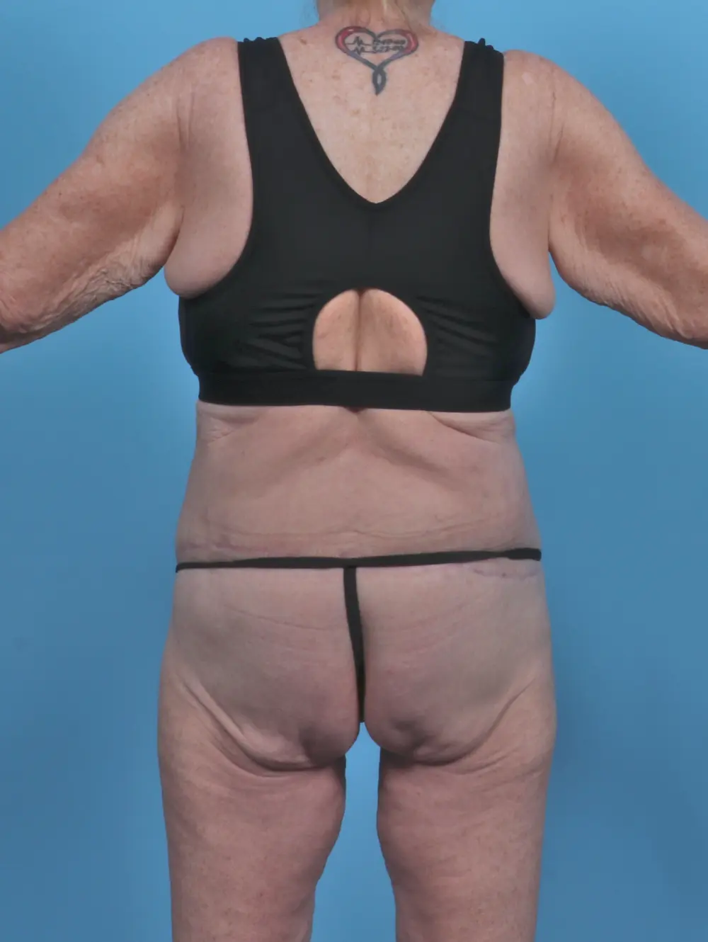 After Weight Loss Patient Photo - Case 46772 - after view-3