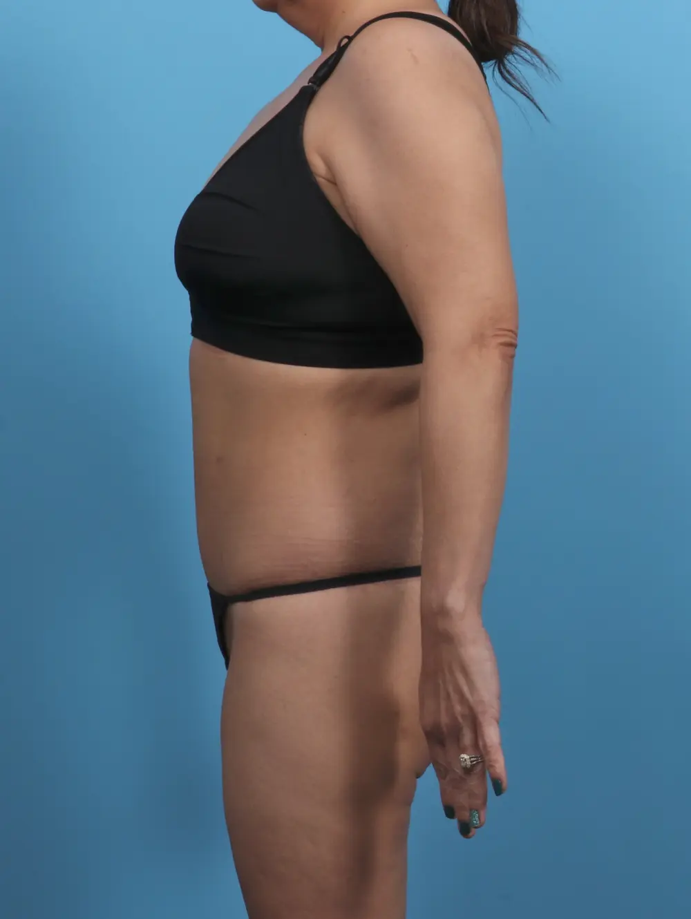 Body Lift Patient Photo - Case 46808 - after view-2