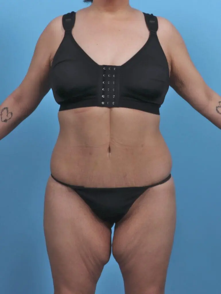 Body Lift - Case 46808 - After