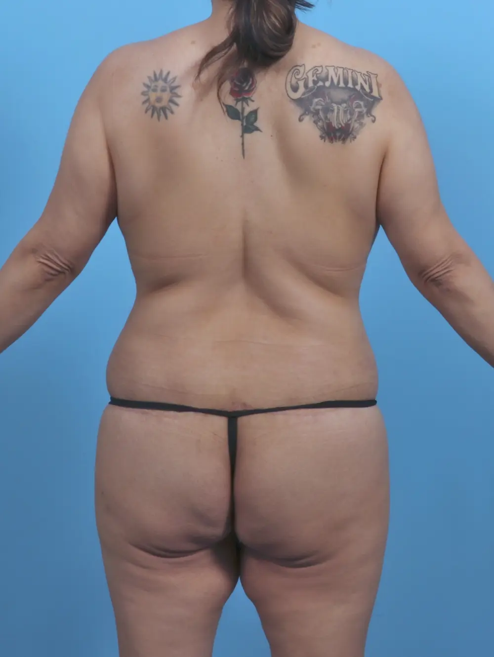 Body Lift Patient Photo - Case 46808 - after view-3