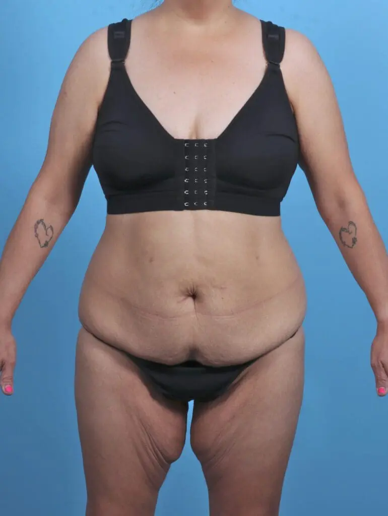 Body Lift - Case 46808 - Before