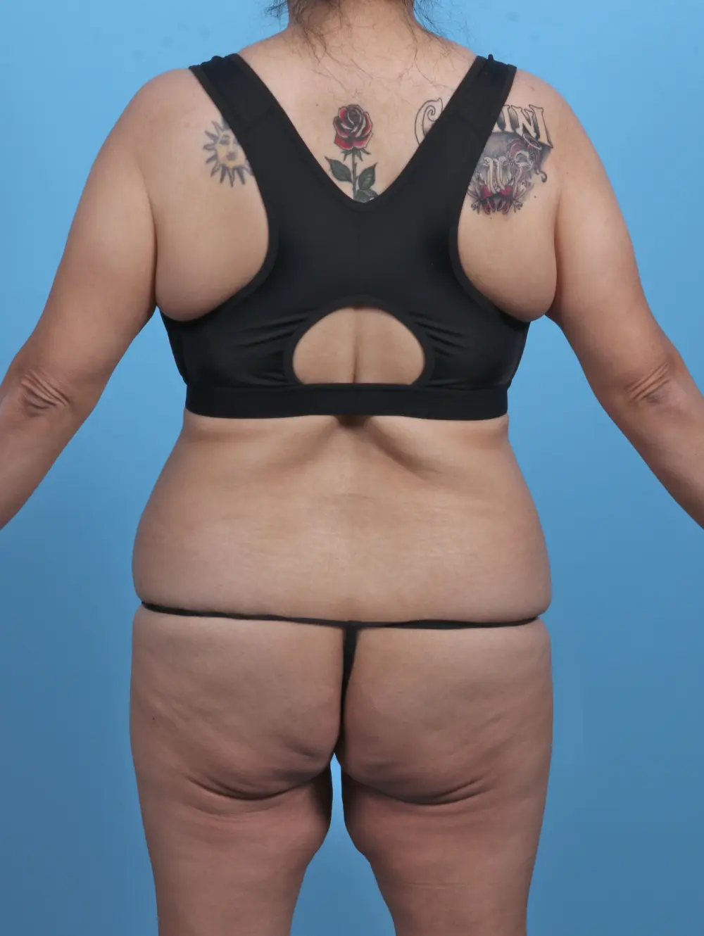 Body Lift Patient Photo - Case 46808 - before view-3