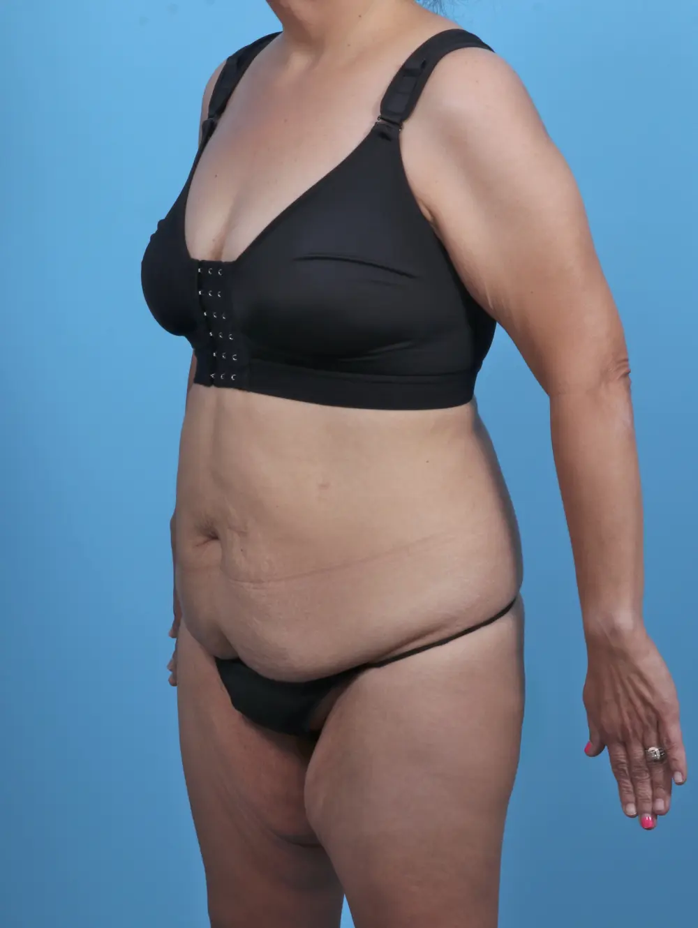 Body Lift Patient Photo - Case 46808 - before view-1