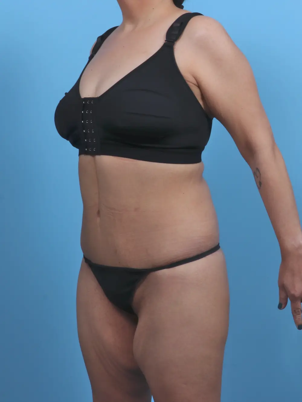 Body Lift Patient Photo - Case 46808 - after view-1