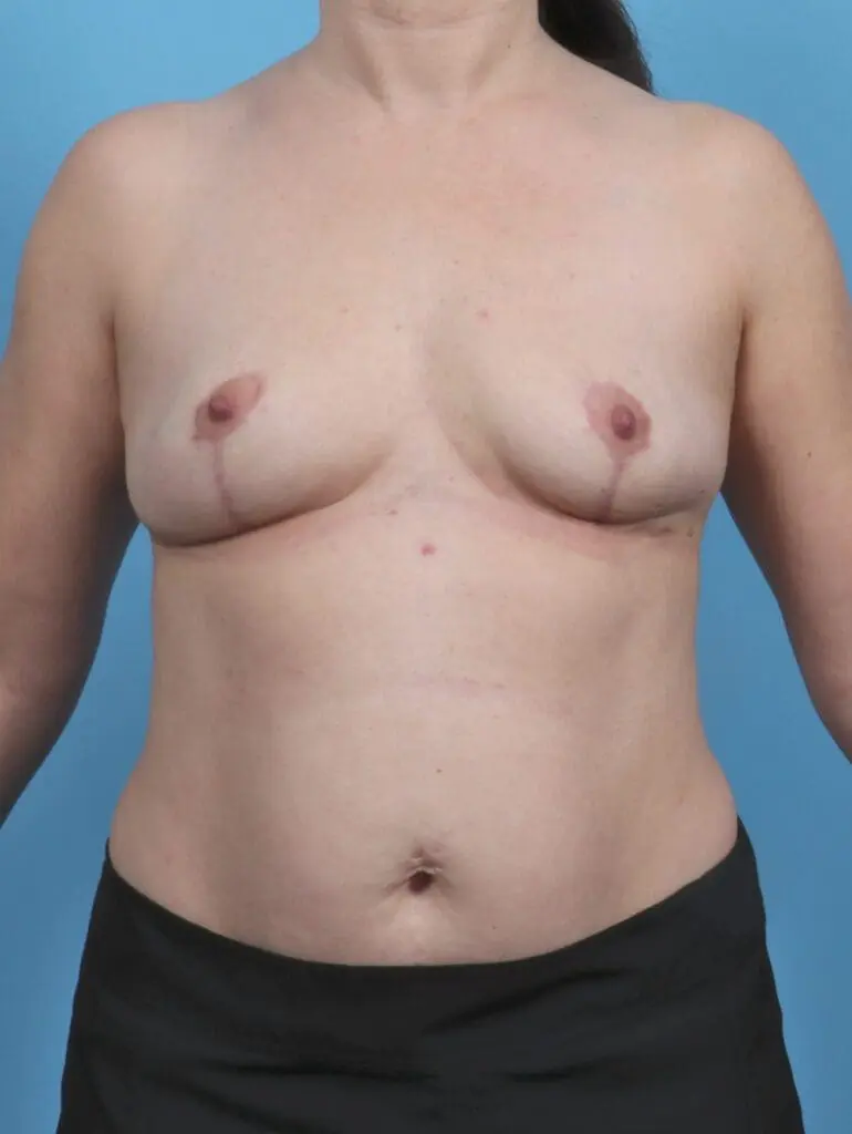 Breast Implant Removal - Case 46818 - After