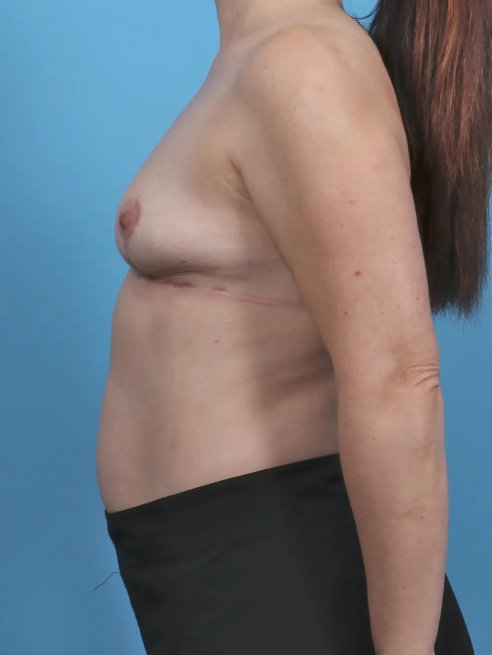 Breast Implant Removal Patient Photo - Case 46818 - after view-2