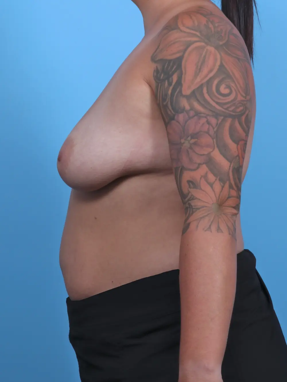 Breast Lift/Reduction with Implants Patient Photo - Case 46835 - before view-2