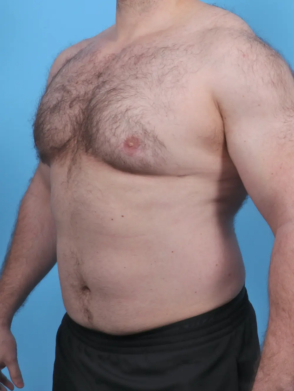 Gynecomastia Patient Photo - Case 46843 - after view-1