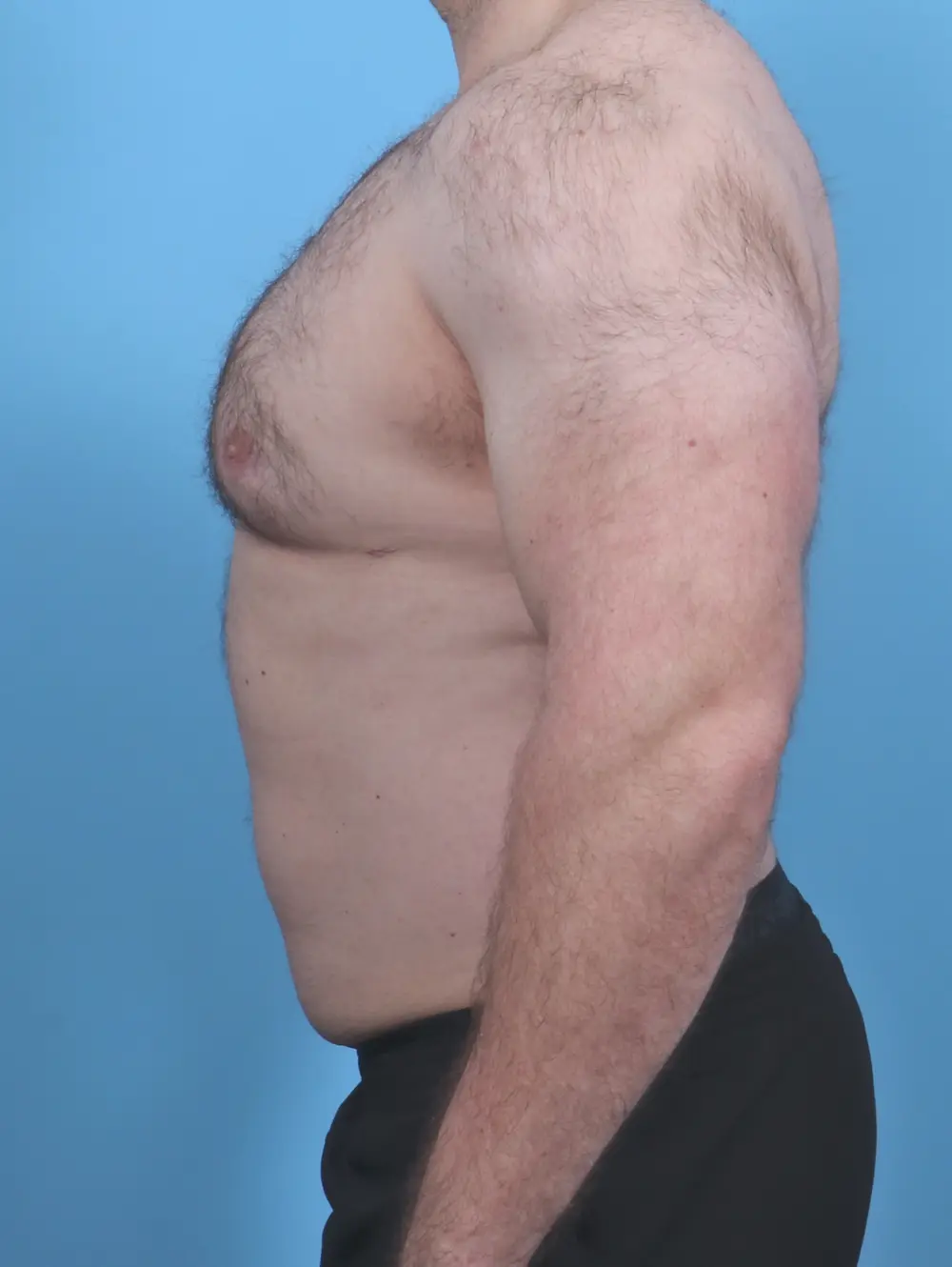 Gynecomastia Patient Photo - Case 46843 - after view-2