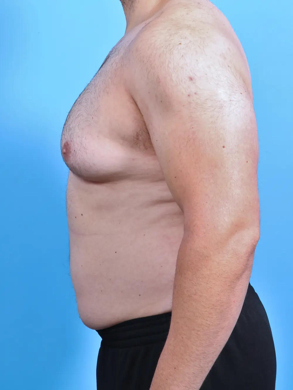 Gynecomastia Patient Photo - Case 46843 - before view-2