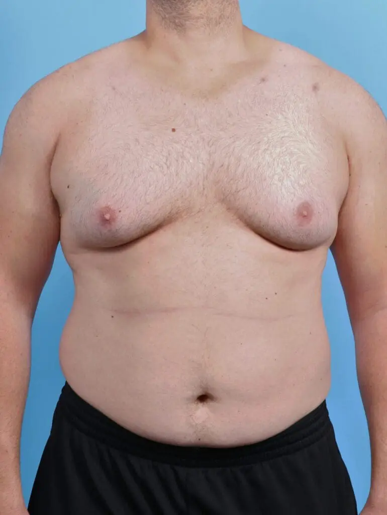 Gynecomastia - Case 46843 - Before