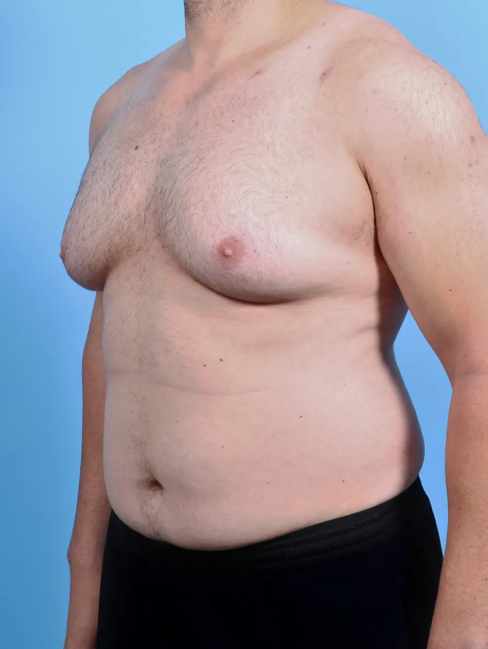 Gynecomastia Patient Photo - Case 46843 - before view-1