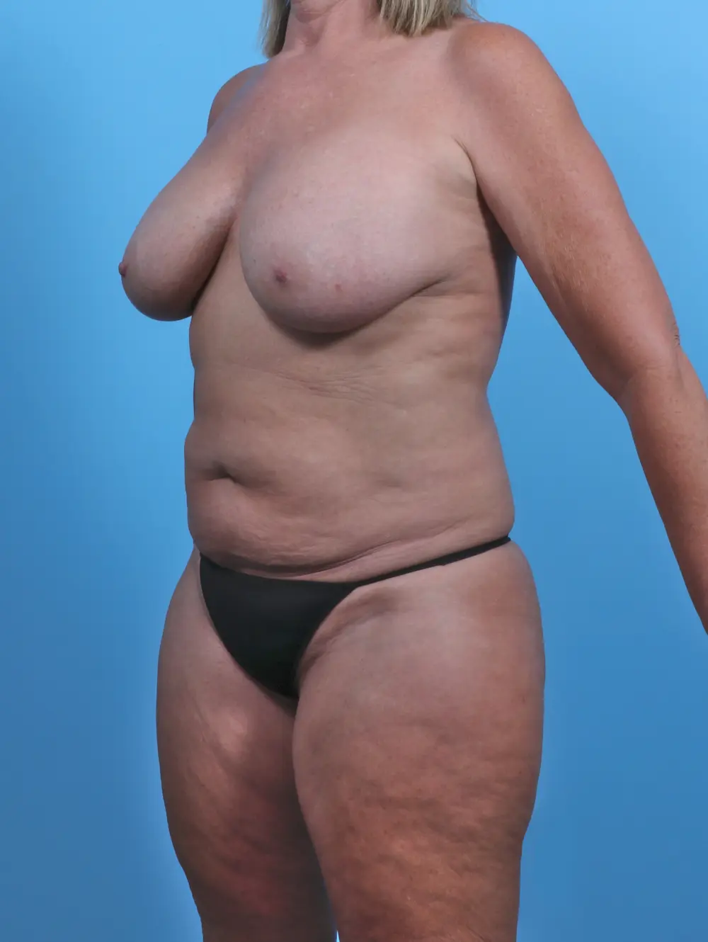 Breast Lift/Reduction with Implants Patient Photo - Case 46851 - before view-2