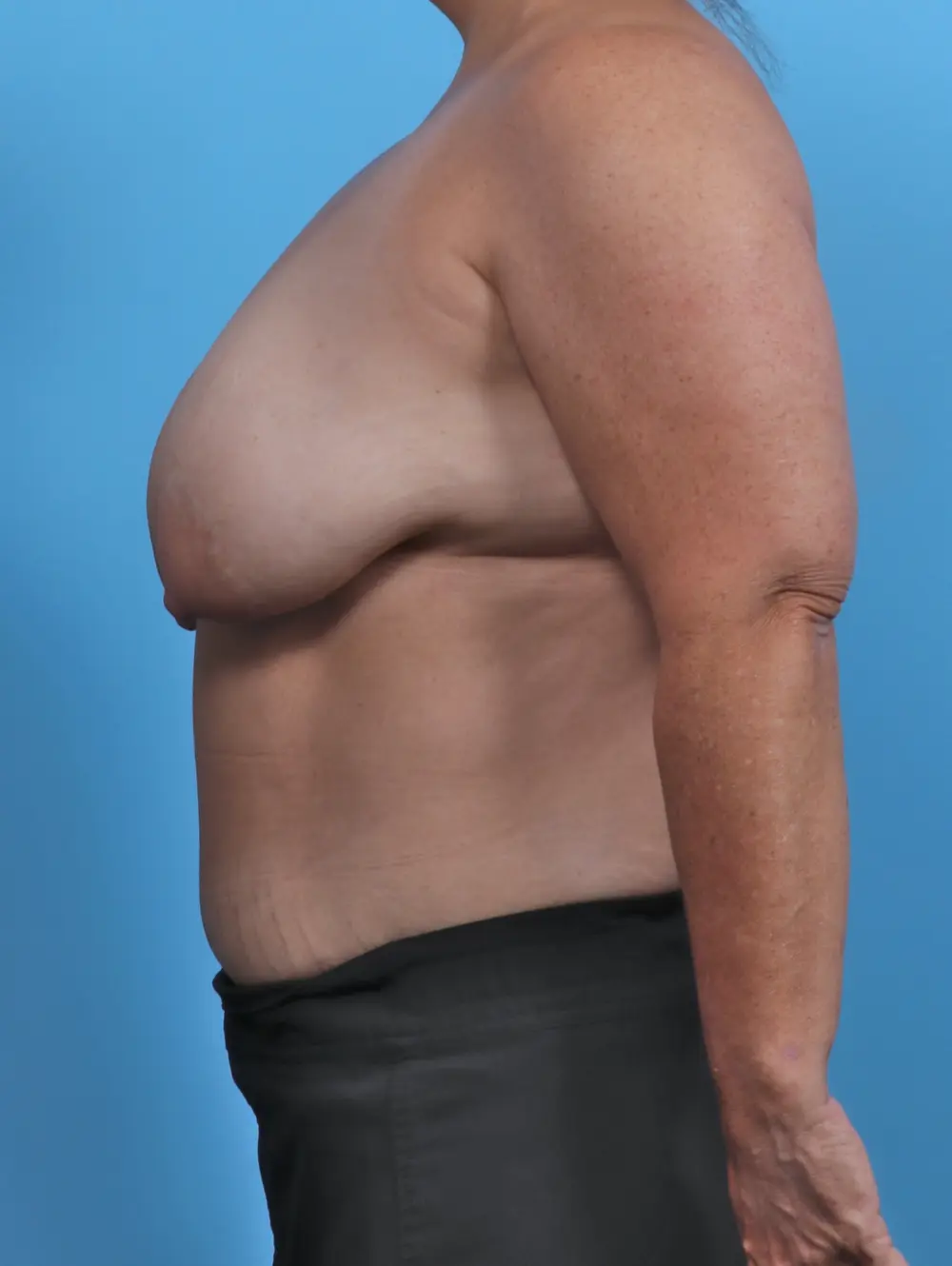 Breast Lift/Reduction w/o Implants Patient Photo - Case 46861 - before view-2