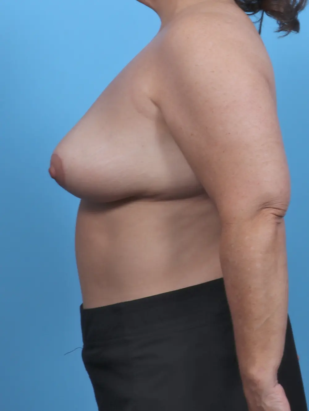Breast Lift/Reduction w/o Implants Patient Photo - Case 46861 - after view-2