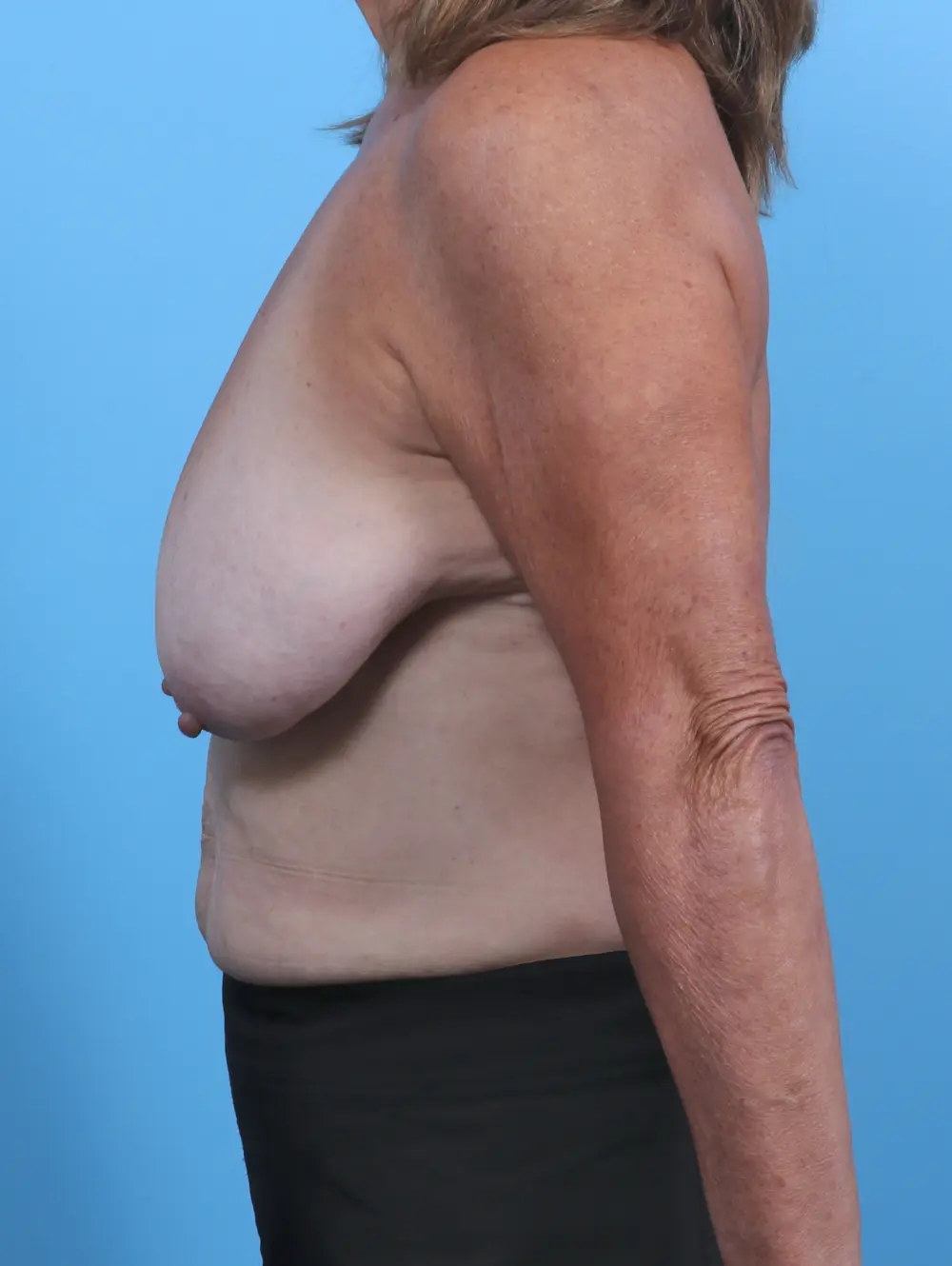 Breast Lift/Reduction w/o Implants Patient Photo - Case 46878 - before view-2