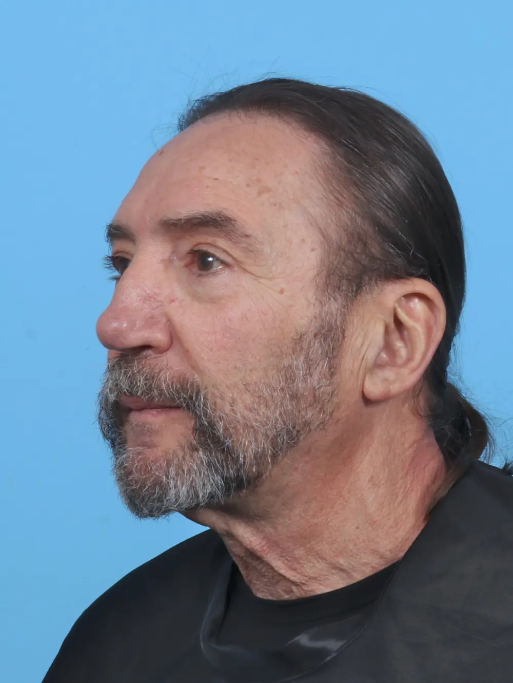 Eyelid Surgery Patient Photo - Case 46886 - after view-1